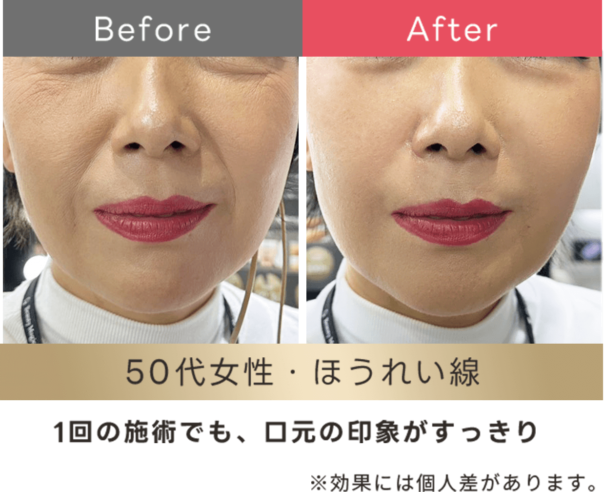 1回の背術でも口元の印象がスッキリ