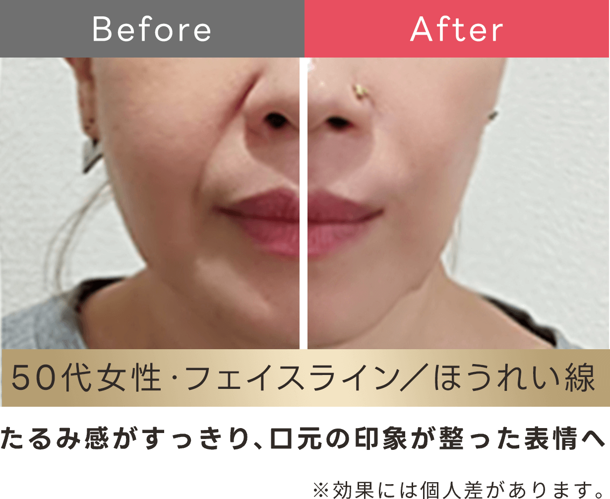 たるみ感がスッキリ、口元の印象が整った表情へ