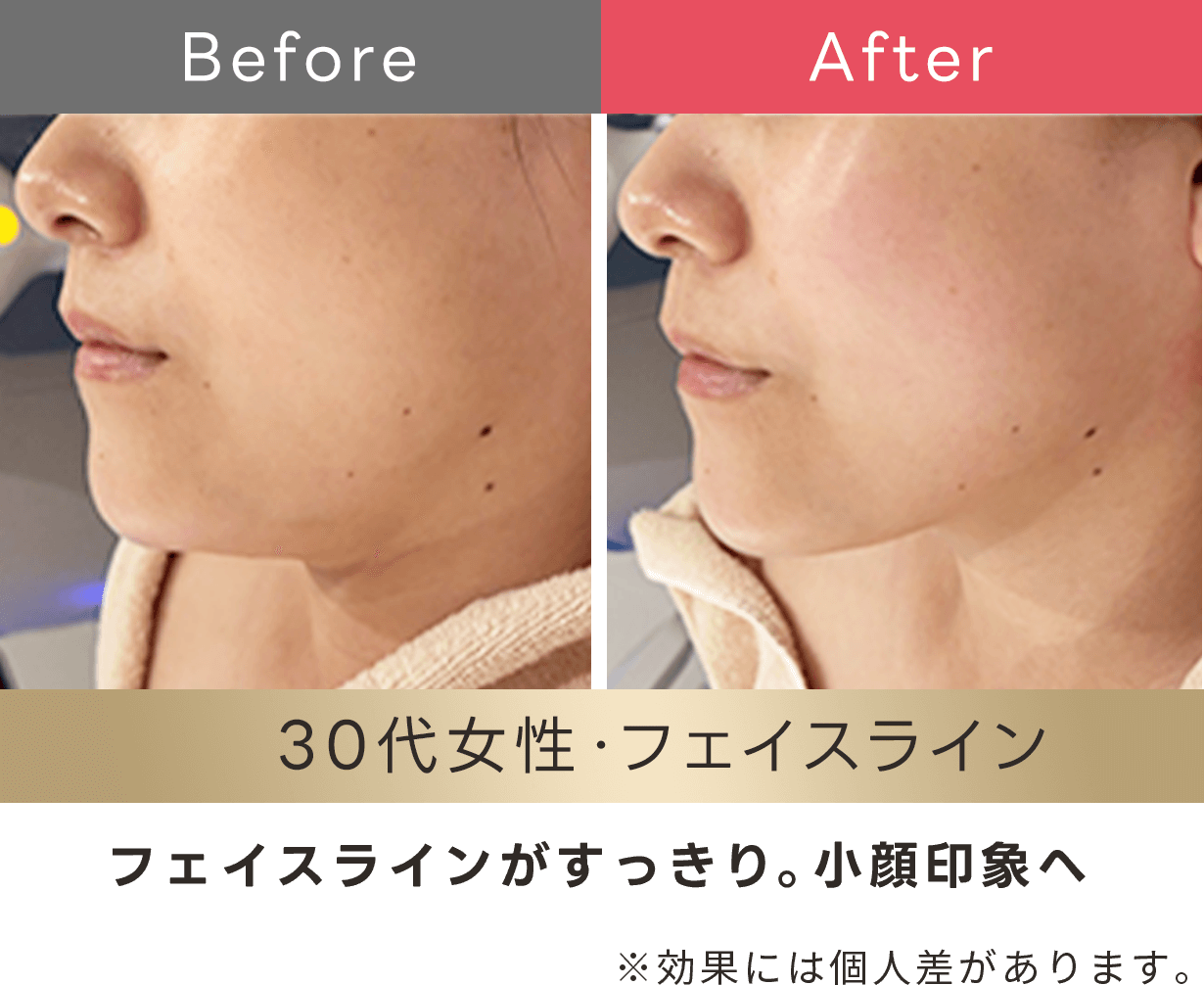 フェイスラインがスッキリ。小顔印象へ